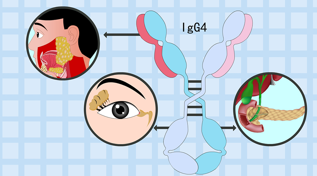 一文帶你了解IgG4這個指標(biāo)